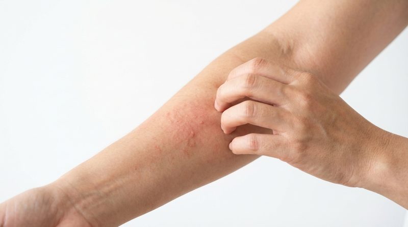 Close-up of irritated skin on forearm